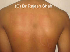 Appearance of dermatographism on back skin